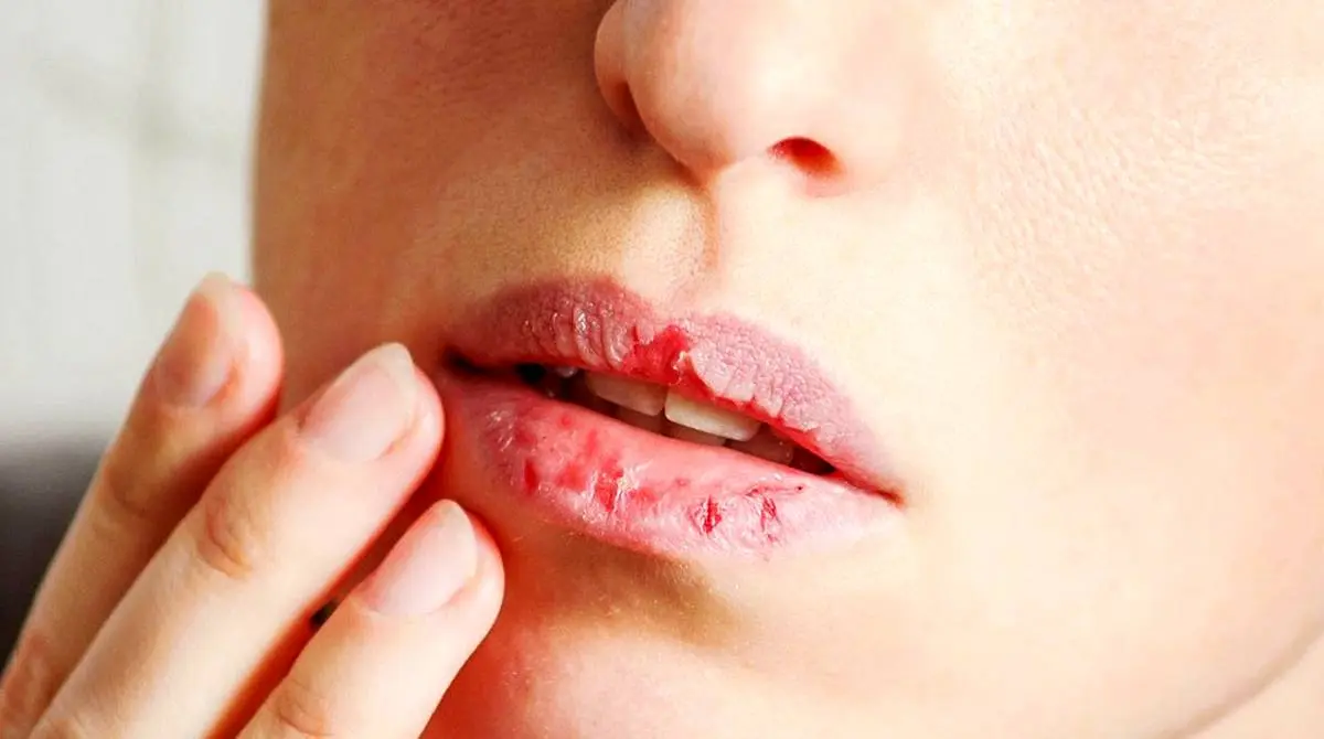 ویروس کرونا | آیا خشکی دهان از علائم ابتلا به آلودگی است؟