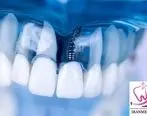 مراحل ایمپلنت دندان و جراحی ایمپلنت چقدر طول میکشد؟
