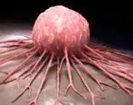 نرخ مرگ و میر در مردان مبتلا به سرطان سینه بیشتر است