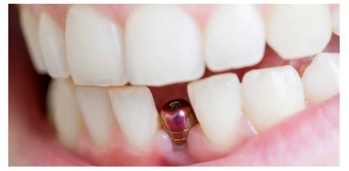 چه معیارهایی برای انتخاب بهترین کلینیک ایمپلنت دندان باید در نظر بگیریم؟
