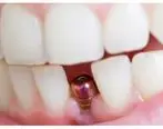 چه معیارهایی برای انتخاب بهترین کلینیک ایمپلنت دندان باید در نظر بگیریم؟
