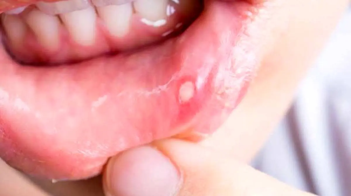 نحوه درمان آفت دهان کودکان به روش طب سنتی