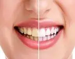 ۷ نکته کلیدی برای سفیدی دندان