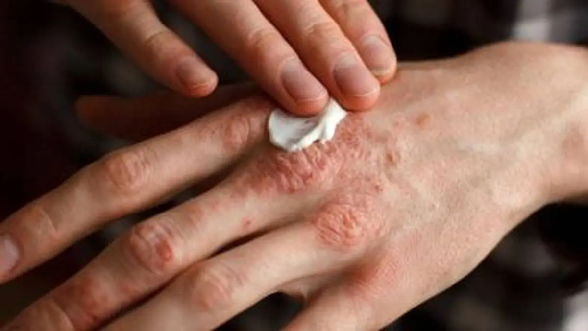 باشایع ترین بیماری های پوستی آشنا شوید
