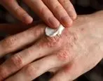 باشایع ترین بیماری های پوستی آشنا شوید
