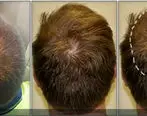 از ریزش مو در مردان چه می دانید؟ + راه های درمان