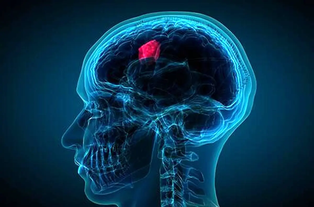 درمان تومور مغزی در کشور با اختراع فناوری نوین
