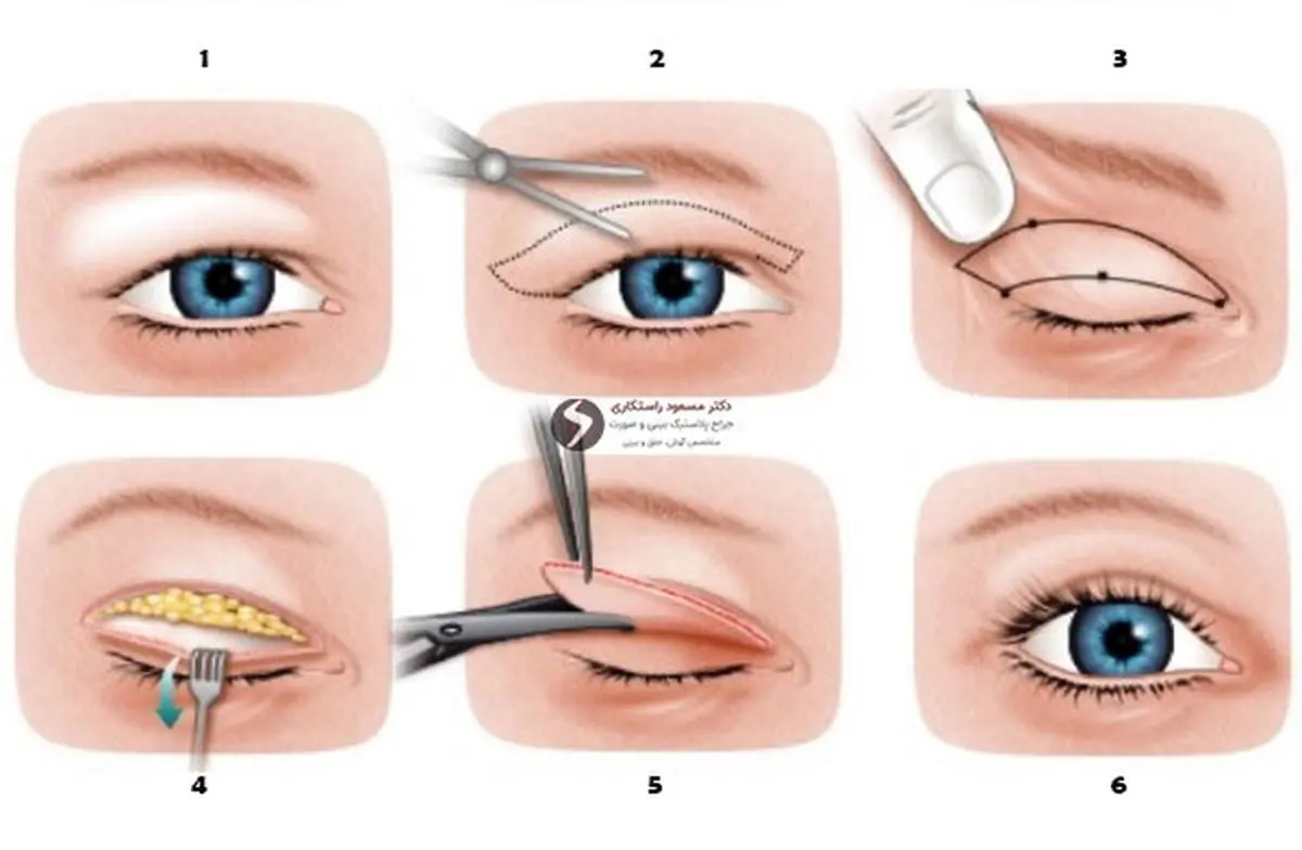 چند درصد مردم ایران جراحی پلک انجام میدهند؟/ عوارض جراحی پلک چیست؟ 
