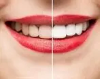 پیشگیری از جرم دندان با چند روش طبیعی
