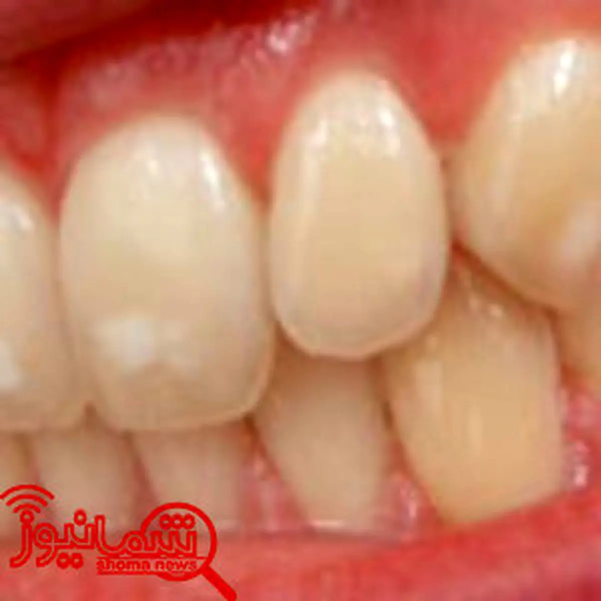 روش‌هایی برای رهایی از لکه‌های سفید دندان