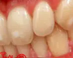روش‌هایی برای رهایی از لکه‌های سفید دندان