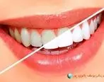 چگونه از شر دندان های بدرنگ خلاص شویم؟