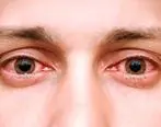 
چند دلیل اصلی قرمزی چشم ها و درمان آن
