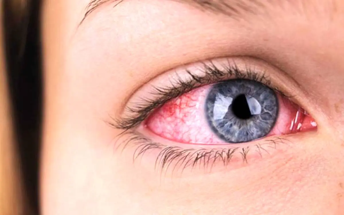 علت قرمزی چشم چیست + راه های درمان
