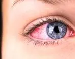 علت قرمزی چشم چیست + راه های درمان
