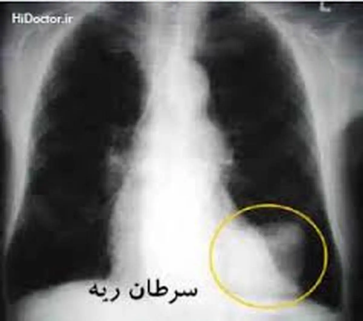 داروی جدید برای سرطان ریه