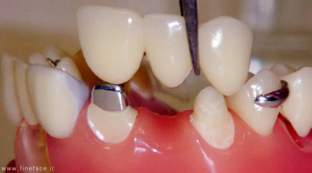 بریج دندان چیست؟  + مزایا و معایب 