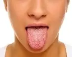 رایج ترین علل خشکی دهان را بشناسید