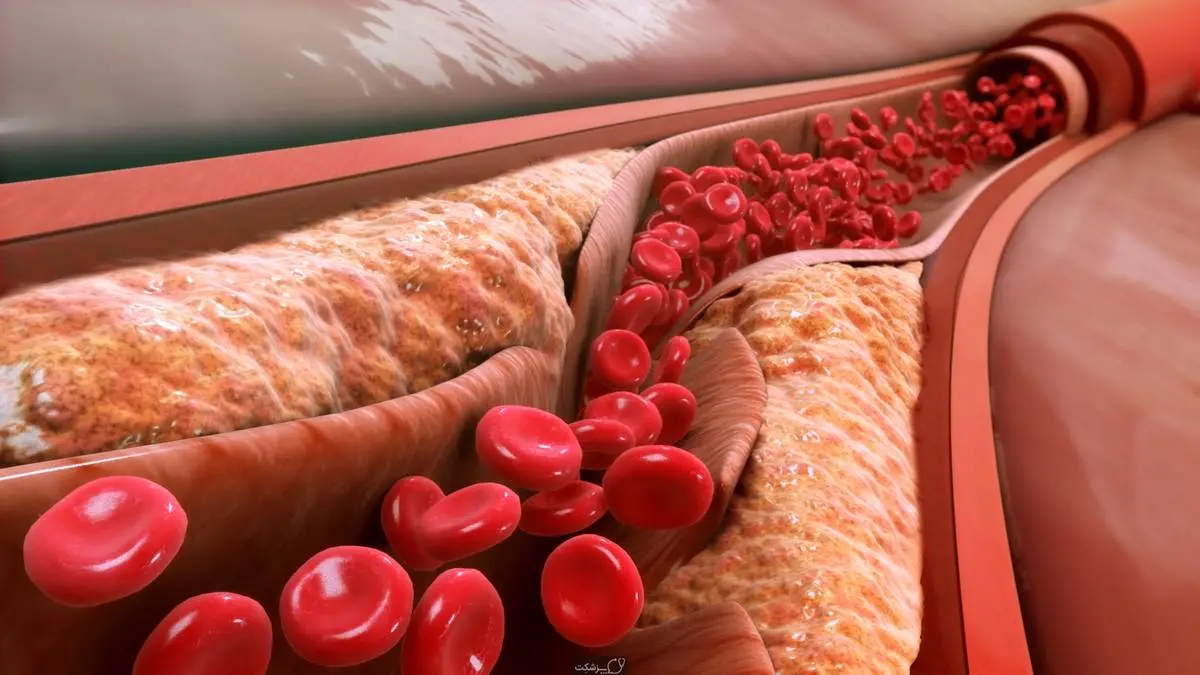 چگونه کلسترول خون را به سرعت کاهش دهیم؟ + راه درمان