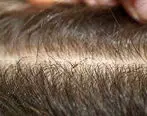 درمان شپش موی سر با اسپند 