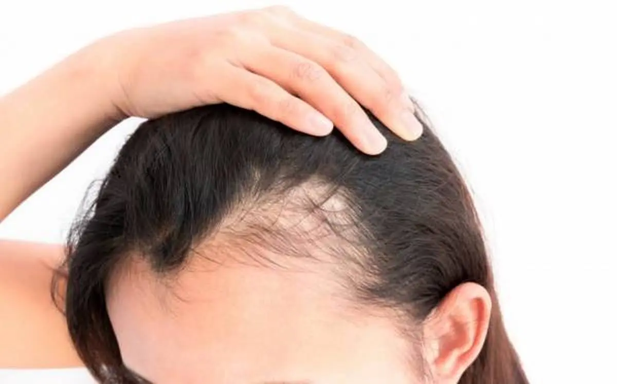 از تاثیرات غدد بدن بر ریزش مو چه می دانید؟