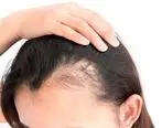 از تاثیرات غدد بدن بر ریزش مو چه می دانید؟