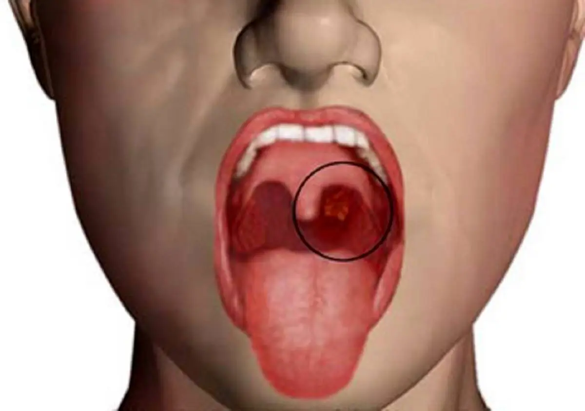 علائم خطرناکی که خبر از ابتلا به سرطان دهان می دهد