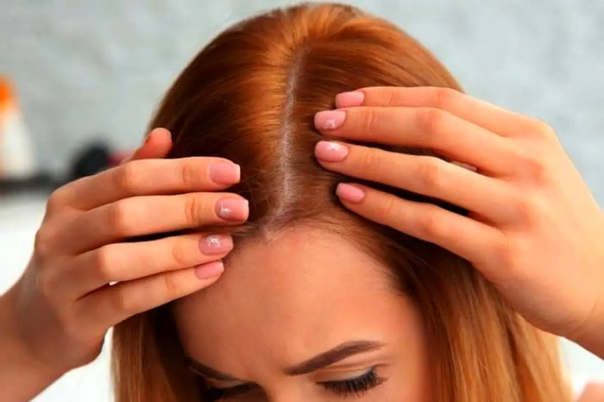 علت ریزش موی زنان در هر سنی چیست؟