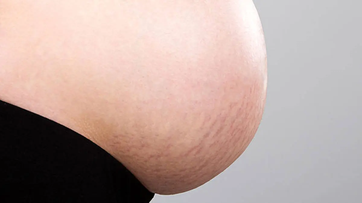 چگونه از ترک های پوستی دوران بارداری جلوگیری کنیم ؟