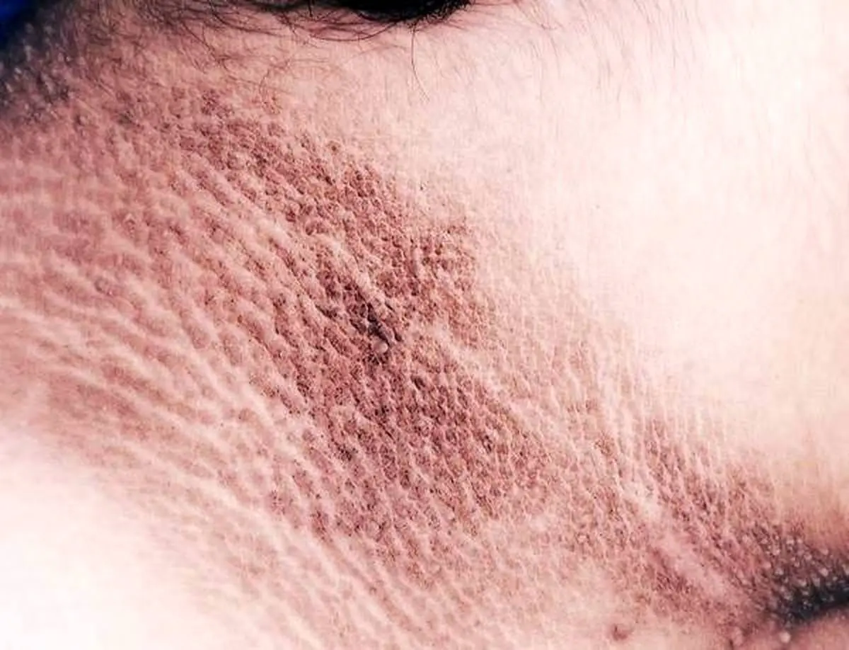 بیماری پوستی آکانتوزیس نیگریکانس چیست؟