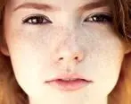 درمان لک های پوست صورت را با این چند ترکیب ساده از بین ببرید