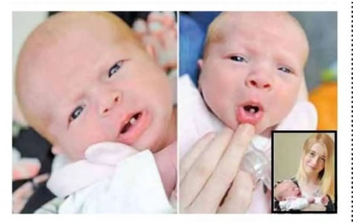 نوزادی که با یک دندان به دنیا آمد! + عکس