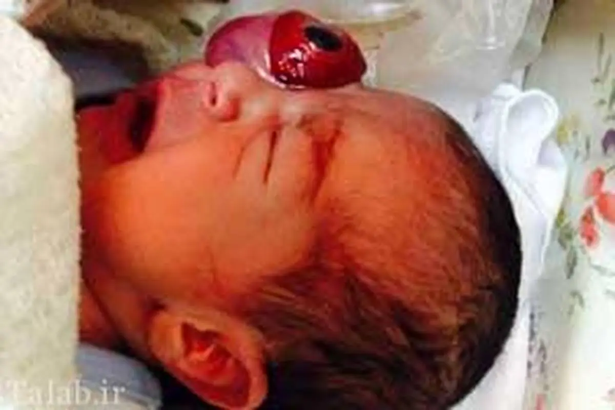 یک نوزاد با چشم بیرون از حدقه متولد شد 