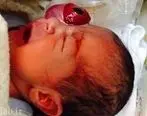 یک نوزاد با چشم بیرون از حدقه متولد شد 