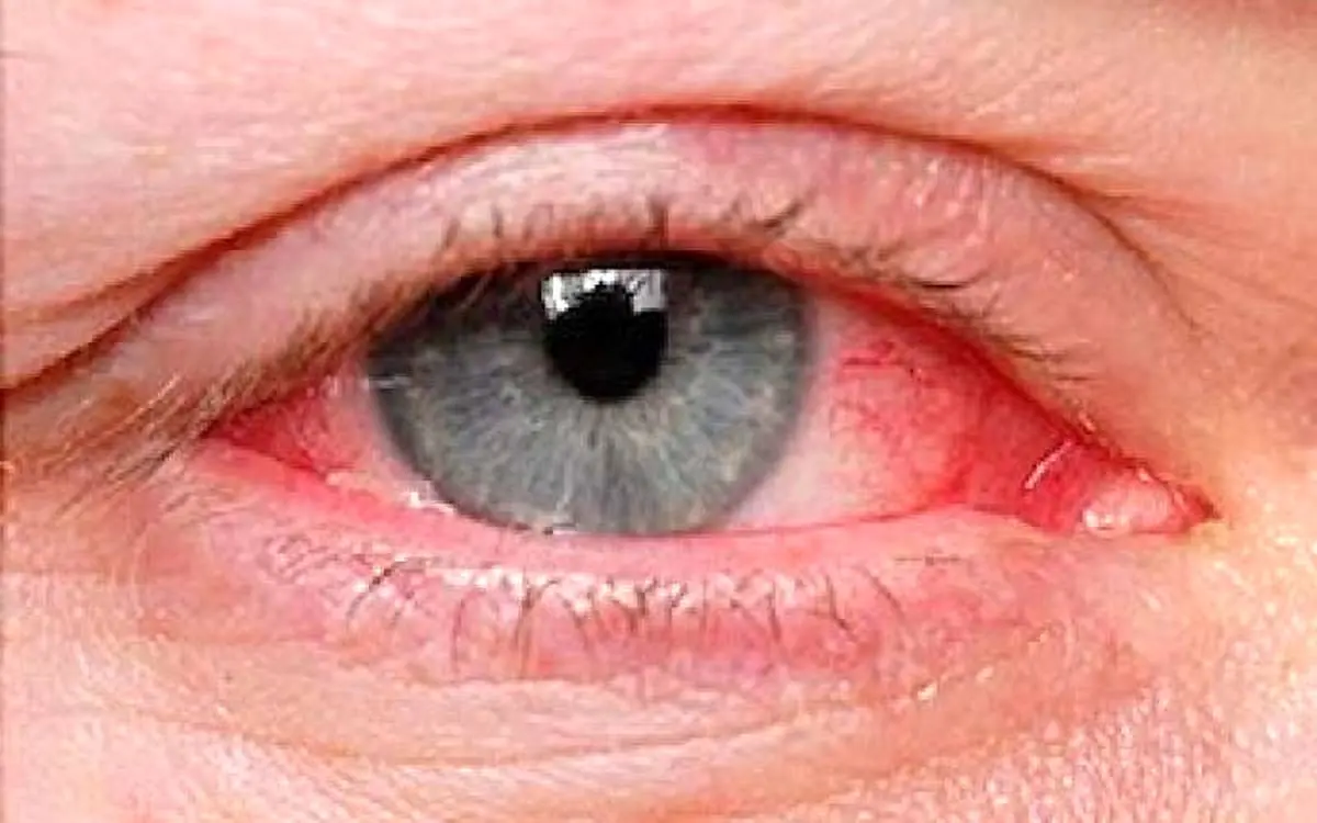در فصل گرما مراقب این بیماری چشمی شایع باشید